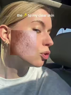 Microneedling results at home, these are insannnne #microneedling #microneedlingserum #microneedlingtherapy #microneedlingface #acnescars 
