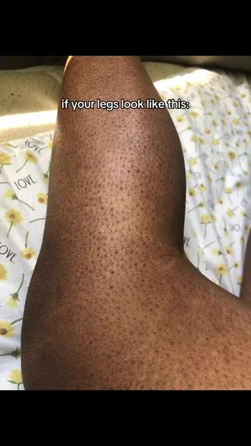 @medicube global us strawberry skin girls thank you 🙏🏻❣️ the easiest solution to fix strawberry legs, strawberry skin and leg texture❣️ #strawberrylegstips #strawberryskin #smoothlegs #summeressentials #Tiktokshopstockup @medicube US Store 