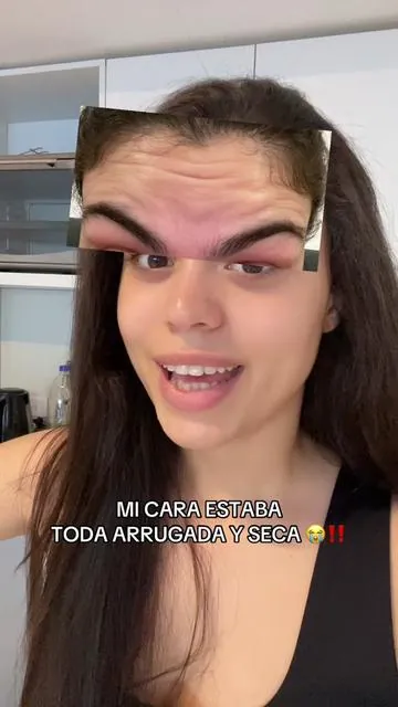 Yo antes del BOTOX y ahora??? 🤭 tambien sin botox!! #antiedad #rejuvenecimiento #pdrn 