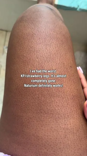 If you’ve been hiding your legs… this is your sign 🍓✨ Naturium KP Duo targets strawberry legs + KP at the source—glycolic acid wash + KP scrub work together to smooth bumps, unclog pores, and reveal visibly softer skin.  Consistency = real skin texture change you can feel.@Naturium  #strawberrylegsremedy #keratosispilaris #bodycareroutine #naturium #tiktokshopfinds