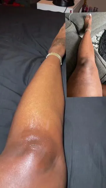This is what I’ve been using on the appearance of marks on my legs.” #drmelaxin #drmelaxintonerpads #drmelaxinskincare @Dr.Melaxin Official 