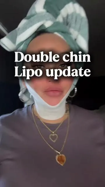 Double chin lipo update #doublechin #doublechinreduction #chinlipo #queencempire #facelift 