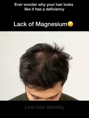 Different deficiencies for hair 🤔 #dht #dhtblocker #hairloss 