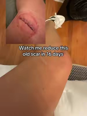 Actual daily footage for 16 straight mornings of reducing the appearance of my scar. Had stitches 3 years ago! So it's been there a while. This silicone stick is working. #scartreatment #reducescars #scarringskincare #scarstick #skincareroutine 