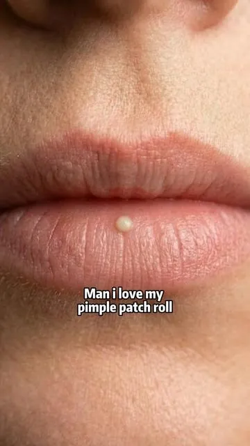 #fyp #pimple #pimplepatch #SummerWins #tiktokshopdealsforyoudays 