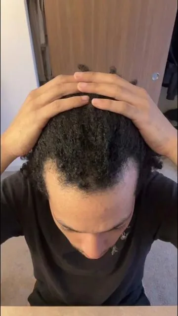 If you start seeing slight recession that doesn’t mean, cover it with your taper or ignore it, you need to act now before it gets worse overtime. ##creatorsearchinsights##balding##hairloss##menbalding##baldingyoung