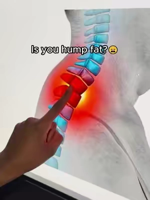 Is your hump actually fat??? #posture #fyp  #DealsForYouDays #SummerWins #thememorialdays