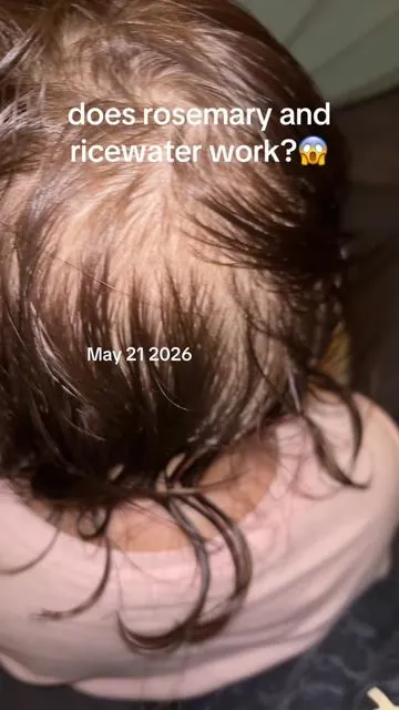 If your hair isn’t growing, watch the end of this video. Couldn’t be more grateful for this product it has genuinely helped my family. I hope this can help someone else . We are not all the same so I can’t make promises that it will work for you, but It did work for my daughter and me.❤️ #hairloss #hairgrowthjourney #dealsforyoudays #paratiiiiiiiiiiiiiiiiiiiiiiiiiiiiiii #healthtok 