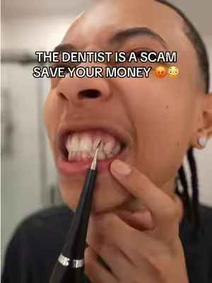 Only thing that worked for me! #DealsForYouDays #plaqueremover #dentalcare #oralhealth #oralhygiene 