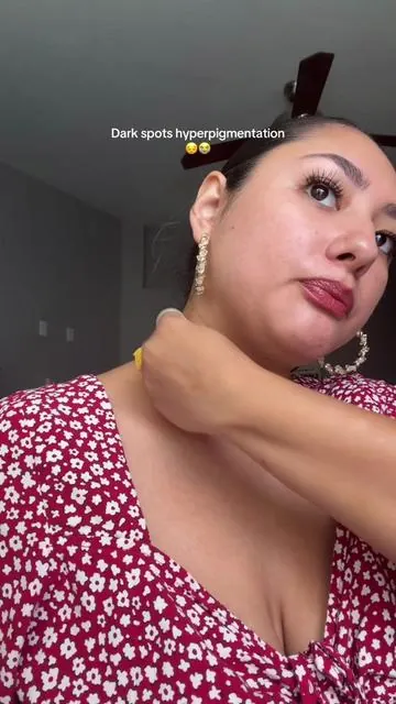 Dark spots, uneven skin tone, hyper pigmentation that’s why I’m using turmeric Kojic acid with Tranexamic by @@Dr.Melaxin