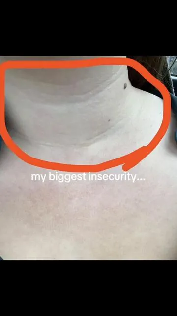 finally found something to get rid of my bad tech neck and neck lines + wrinkles 😭❤️🙏🏻 @medicube global @medicube US Store Medicube PDRN collagen gua sha neck wrinkle cream tiktok shop #techneck #technecksolutions #neckwrinkles #medicubeskincare #DealsforyouDays  Medicube PDRN collagen gua sha neck wrinkle cream tech neck solution fix tech neck lines neck wrinkles fine lines firming cream tiktok shop buy with coupon