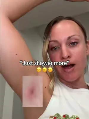 Acne, boils, cysts shouldn’t even exist 🤬 #hydradenitissuppurativa #cysts #acneproneskin #tiktokshopcreatorpicks #boils 