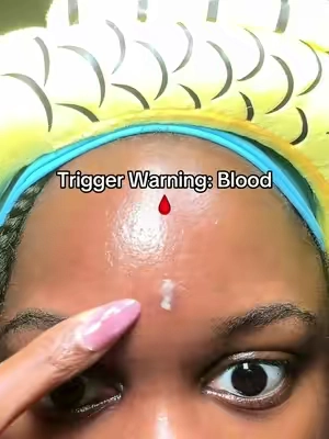 Replying to @blueluxevibes it popped my pimple #medicubepimplepatch #medicubeskincare #skincaretiktok #zit #pimplepopping @medicube global 