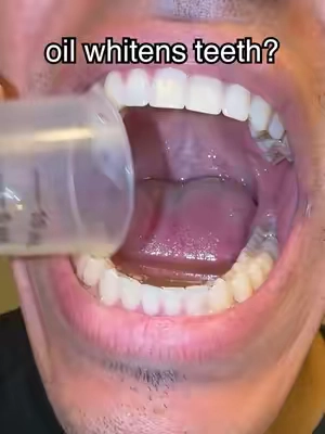 30 days later… 👀 #gaptaincrunch #bracesoff #fyp #TikTokShopCreatorPicks #teethwhitening 