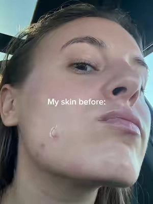 Finally have that glass skin I’ve always dreamed abt #azelaicacid #tretinoin #skincareproducts #glassskinroutine #glassskin @medicube US Store 