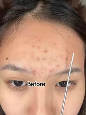 Damaged skin barrier = sudden acne?If you keep breaking out...Don't ignore your skin barrier.Use Dr.Leo CICA Panthenol Jelly Moisturizer.Here is my glow up!💚 #tiktokshopsummersale #skinbarrierrepair #skincare #clearskin #drleohonestreview 