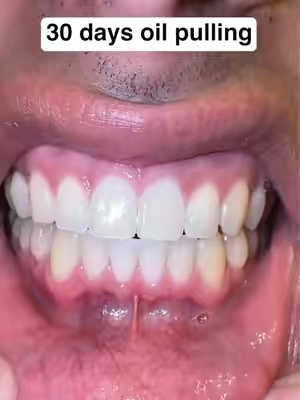 Results after 30 days 😳 #gaptaincrunch #fyp #teethwhitening #viral #TikTokShopCreatorPicks 