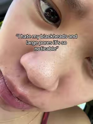 genuinly swear by this stuff #GlowUp #blackhead 