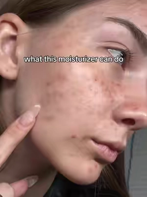 I've used so many bottles of Dr. Leo's soothing cream, and they've truly transformed my skin. They help improve my complexion, calm breakouts, reduce redness, strengthen my skin barrier, and keep my skin deeply hydrated. No matter how many other products I try, I always come back to this one. It's absolutely been a game-changer in my skin recovery journey, and I would choose it over and over again.💚✨ #skinbarrierrepair #breakout #glassskin #skincare #drleohonestreview 