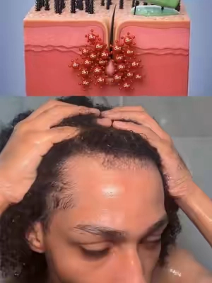 How did I avoid letting my hair loss get worse? I started with my shampoo. Before stacking serums, oils, and other hair growth products, I focused on keeping my scalp clean and switched to a shampoo formulated for DHT-focused hair care. The BSAPY DHT Blocking Shampoo Bar became one part of my routine while I worked on my thinning hairline, temples, and overall scalp health. Start with the foundation, then build the rest of your hair loss routine from there. #creatorsearchinsights #howtonotgobald #fyp #viral #hairloss 