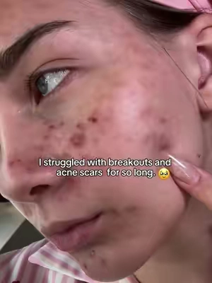 Did it make a difference?… YOU BET!#acnetreatment #skinbarrierrepair #skincare #breakout #drleohonestreview 