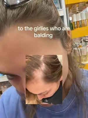 hair loss is so real and so scary @VT Cosmetics US #hairloss #vtcosmetics #hairgrowth #koreanskincare 