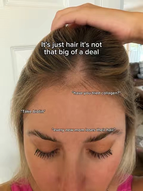 I genuinely didn’t realize how much my hair had changed until I started looking back at old photos. 🥺 My hairline was getting thinner, my part looked wider, and there were areas where I could see way more scalp than I was comfortable with. People love to say “it’s just hair,” but when it’s your hair, it can absolutely affect how you feel about yourself. That’s why I started being consistent with the INIA REGEN Laser + Red Light Cap, and over time I started noticing my hair looking fuller and healthier, especially around the areas that had been bothering me most. ✨ The cap uses low-level laser therapy along with multiple wavelengths of light, including red and near-infrared, with 398 lasers + LEDs designed to provide full-scalp coverage. INIA says the technology is intended to support the scalp and healthier-looking hair density over time.  What made it realistic for me to stay consistent is that the sessions are only about 15 minutes and the cap is completely cordless, so I can put it on while I’m getting ready, working, or just sitting around the house. INIA notes that consistency is important and says users may begin noticing visible changes in hair density and scalp appearance after roughly 12–16 weeks of regular use.  I’m not saying one device is going to magically transform everyone’s hair, and everyone’s results can be different, but looking at where I started versus where my hair is now is kind of wild. 🥹 If you’ve been noticing a widening part, thinner-looking hairline, or just want to start taking better care of your scalp before it gets worse, this is the device I’ve been using. ✨ INIA REGEN Laser + Red Light Cap ✨ 398 lasers + LEDs ✨ 10-minute sessions ✨ cordless + hands-free ✨ designed for thinning hair and scalp support  I wish I had started sooner.