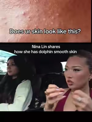 Only 500 left #ninalin #pimples 