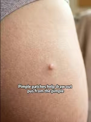 #fyp #tktkpimplepatch #pimplepoping #pimplepatchremoval #pimple 