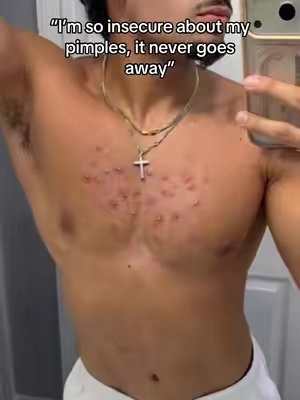 Definitely recommend yall trying this out ASAP! #bodyacne 