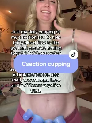 C my pelvic floor therapist told me to do this to help break up scar tissue and improve the look and feel of my c section scar and shelf #csectionmom #csection #cuppingtherapy #csectionscar #csectionshelf 