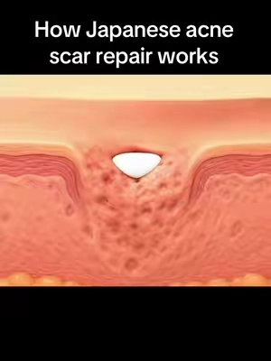 Super easy to work #acne #dralthea #acnescars #confident 