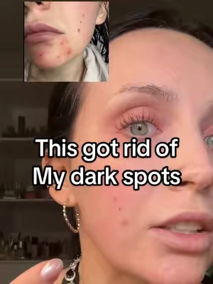 One of the best ways I helped even out my skin tone @Farmacy Beauty #unevenskintone #unevenskin #darkspottreatment #darkspotremoval #skincaretips 