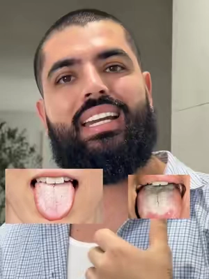 Muchas personas se lavan los dientes pero sienten que el aliento no mejora y eso se debe porque muchas veces quedan bacterias, restos de comida ya sea entre los dientes o principalmente en la lengua, si hacen esto van a notar un cambio muy bueno en su aliento y en la sensación de que la boca si queda limpia  #oralcareroutine #oralhygiene #malaliento #badbreathtreatment #cuidadodental 