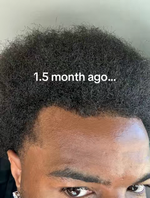 #hairline #beforeandafter #fyp #hairloss #viral 