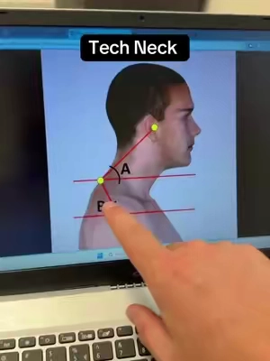 This is one of my biggest tips for tech neck posture! #neckpainrelief #neckpain #posturecorrection #headache #neckpillow 