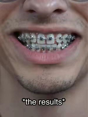 Results after braces for two years 🤯 How I clean my clear retainers ✅ #gaptaincrunch #fyp #teethwhitening #viral #TikTokshopbacktoschool 