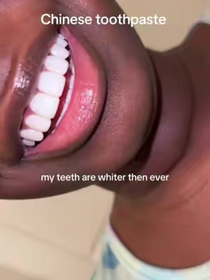 Overly pretty and white! #teethwhitening #hydroxyapatitetoothpaste #oralhealth 
