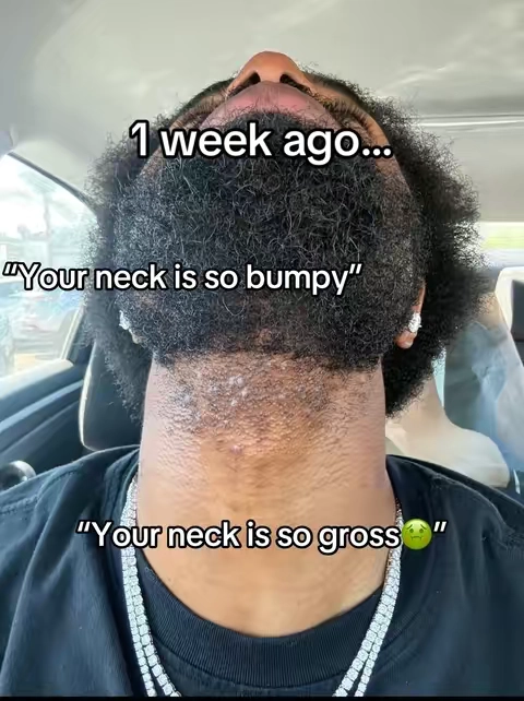 #ingrownhairs #razorbumps #razorbumpsolutions #fyp 