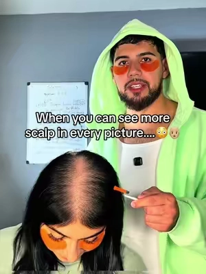 My girl and I both have a lot of experience in the hairloss category I can assure you of that🤕✌🏼