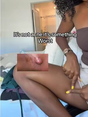 #boils #cyst #hidradenitissuppurativa 